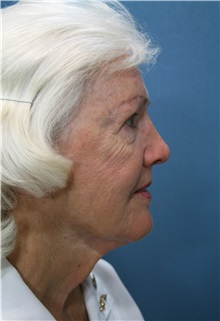 Facelift Before Photo by Marvin Shienbaum, MD; Brandon, FL - Case 37321