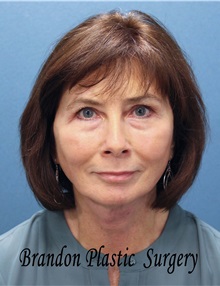 Facelift After Photo by Marvin Shienbaum, MD; Brandon, FL - Case 37324