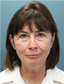 Facelift Before Photo by Marvin Shienbaum, MD; Brandon, FL - Case 37324