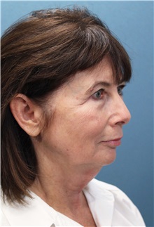 Facelift Before Photo by Marvin Shienbaum, MD; Brandon, FL - Case 37324