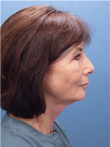 Facelift After Photo by Marvin Shienbaum, MD; Brandon, FL - Case 37324