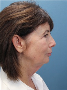 Facelift Before Photo by Marvin Shienbaum, MD; Brandon, FL - Case 37324