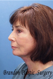 Facelift After Photo by Marvin Shienbaum, MD; Brandon, FL - Case 37324