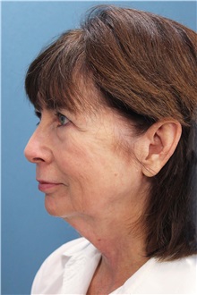 Facelift Before Photo by Marvin Shienbaum, MD; Brandon, FL - Case 37324