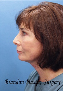 Facelift After Photo by Marvin Shienbaum, MD; Brandon, FL - Case 37324