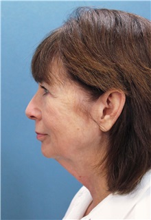 Facelift Before Photo by Marvin Shienbaum, MD; Brandon, FL - Case 37324