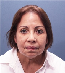 Facelift Before Photo by Marvin Shienbaum, MD; Brandon, FL - Case 37325