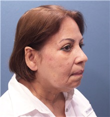 Facelift Before Photo by Marvin Shienbaum, MD; Brandon, FL - Case 37325