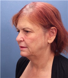 Facelift Before Photo by Marvin Shienbaum, MD; Brandon, FL - Case 37326
