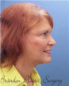 Facelift After Photo by Marvin Shienbaum, MD; Brandon, FL - Case 37326