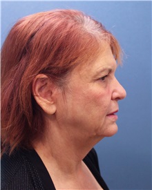 Facelift Before Photo by Marvin Shienbaum, MD; Brandon, FL - Case 37326