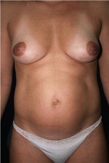 Body Contouring Before Photo by Marvin Shienbaum, MD; Brandon, FL - Case 37505