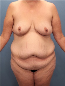 Body Contouring Before Photo by Marvin Shienbaum, MD; Brandon, FL - Case 37506