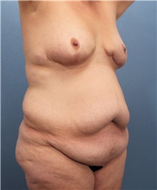 Body Contouring Before Photo by Marvin Shienbaum, MD; Brandon, FL - Case 37506