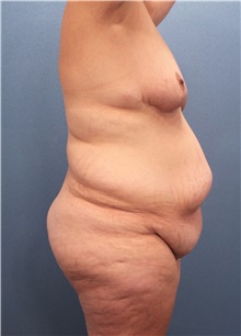 Body Contouring Before Photo by Marvin Shienbaum, MD; Brandon, FL - Case 37506