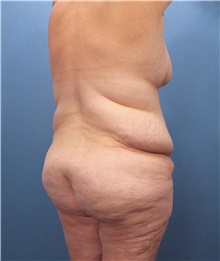 Body Contouring Before Photo by Marvin Shienbaum, MD; Brandon, FL - Case 37506