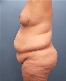 Body Contouring Before Photo by Marvin Shienbaum, MD; Brandon, FL - Case 37506