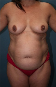 Body Contouring Before Photo by Marvin Shienbaum, MD; Brandon, FL - Case 37508