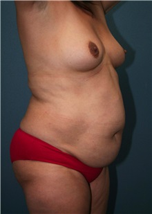 Body Contouring Before Photo by Marvin Shienbaum, MD; Brandon, FL - Case 37508