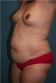 Body Contouring Before Photo by Marvin Shienbaum, MD; Brandon, FL - Case 37508