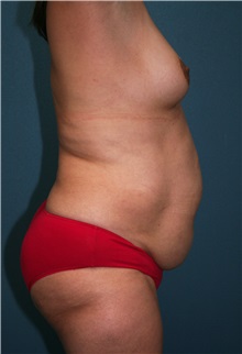 Body Contouring Before Photo by Marvin Shienbaum, MD; Brandon, FL - Case 37508