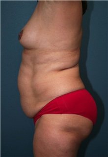 Body Contouring Before Photo by Marvin Shienbaum, MD; Brandon, FL - Case 37508