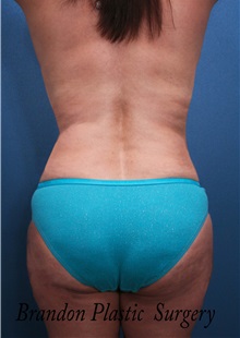 Body Contouring After Photo by Marvin Shienbaum, MD; Brandon, FL - Case 37508