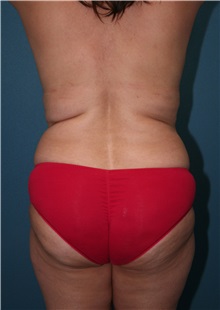 Body Contouring Before Photo by Marvin Shienbaum, MD; Brandon, FL - Case 37508