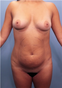 Body Contouring Before Photo by Marvin Shienbaum, MD; Brandon, FL - Case 37509