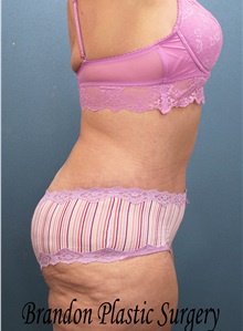 Body Contouring After Photo by Marvin Shienbaum, MD; Brandon, FL - Case 37510