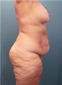 Body Contouring Before Photo by Marvin Shienbaum, MD; Brandon, FL - Case 37510