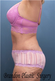 Body Contouring After Photo by Marvin Shienbaum, MD; Brandon, FL - Case 37510