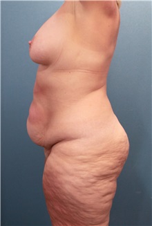 Body Contouring Before Photo by Marvin Shienbaum, MD; Brandon, FL - Case 37510