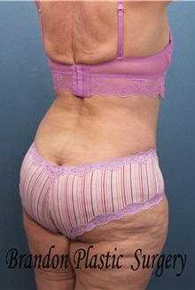 Body Contouring After Photo by Marvin Shienbaum, MD; Brandon, FL - Case 37510