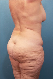 Body Contouring Before Photo by Marvin Shienbaum, MD; Brandon, FL - Case 37510