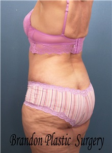 Body Contouring After Photo by Marvin Shienbaum, MD; Brandon, FL - Case 37510