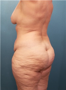 Body Contouring Before Photo by Marvin Shienbaum, MD; Brandon, FL - Case 37510