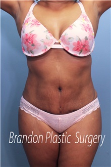 Tummy Tuck After Photo by Marvin Shienbaum, MD; Brandon, FL - Case 44253