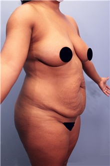 Tummy Tuck Before Photo by Marvin Shienbaum, MD; Brandon, FL - Case 44253