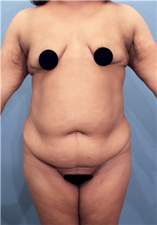 Tummy Tuck Before Photo by Marvin Shienbaum, MD; Brandon, FL - Case 44555