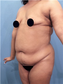 Tummy Tuck Before Photo by Marvin Shienbaum, MD; Brandon, FL - Case 44555