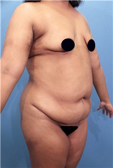 Tummy Tuck Before Photo by Marvin Shienbaum, MD; Brandon, FL - Case 44555