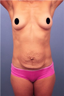 Tummy Tuck Before Photo by Marvin Shienbaum, MD; Brandon, FL - Case 44556