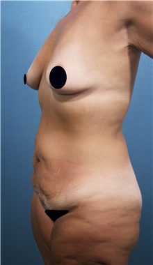 Tummy Tuck Before Photo by Marvin Shienbaum, MD; Brandon, FL - Case 44619