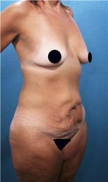 Tummy Tuck Before Photo by Marvin Shienbaum, MD; Brandon, FL - Case 44619