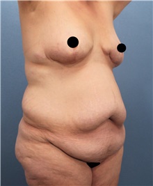 Tummy Tuck Before Photo by Marvin Shienbaum, MD; Brandon, FL - Case 44620