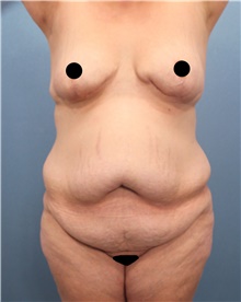 Tummy Tuck Before Photo by Marvin Shienbaum, MD; Brandon, FL - Case 44620