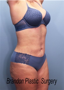 Tummy Tuck After Photo by Marvin Shienbaum, MD; Brandon, FL - Case 44708