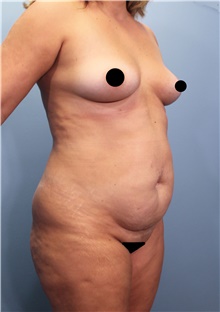 Tummy Tuck Before Photo by Marvin Shienbaum, MD; Brandon, FL - Case 44708