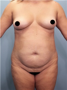 Tummy Tuck Before Photo by Marvin Shienbaum, MD; Brandon, FL - Case 44708